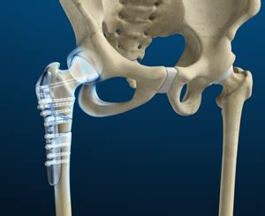 Hip Fracture ORIF - Florida Ortho Care