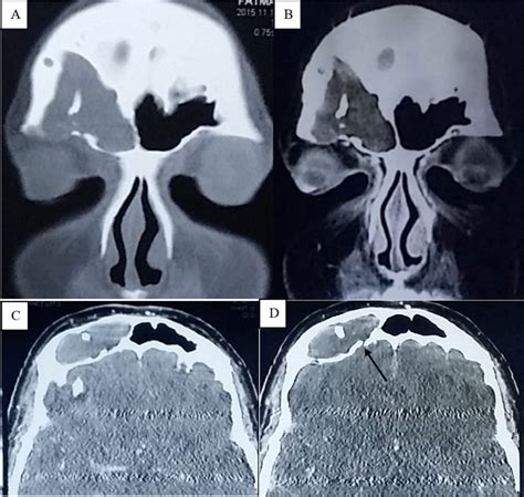 CT scan, bone (A) and soft tissue (B–D) windows, showing a soft tissue ...