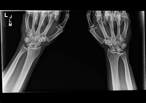 OrthoDx: Scapholunate Ligament Injury - Clinical Advisor