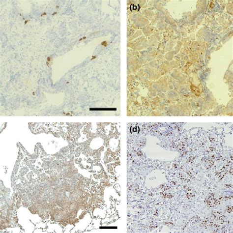 Immunohistochemistry of lung squamous cell carcinoma induced by ...