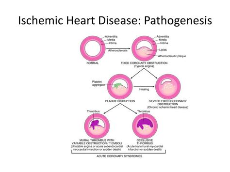 Pathophysiology Of Ischemic Heart Disease