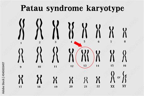 Patau syndrome karyotype is the one of chromosomal disorders that have ...