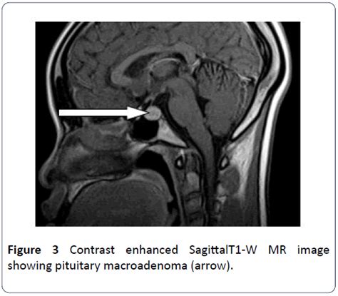 Pituitary Tumor Mri