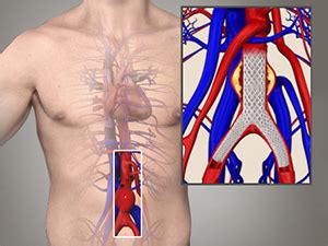 Endovascular Stent Graft Sydney | Thoracic Aortic Aneurysm Sydney