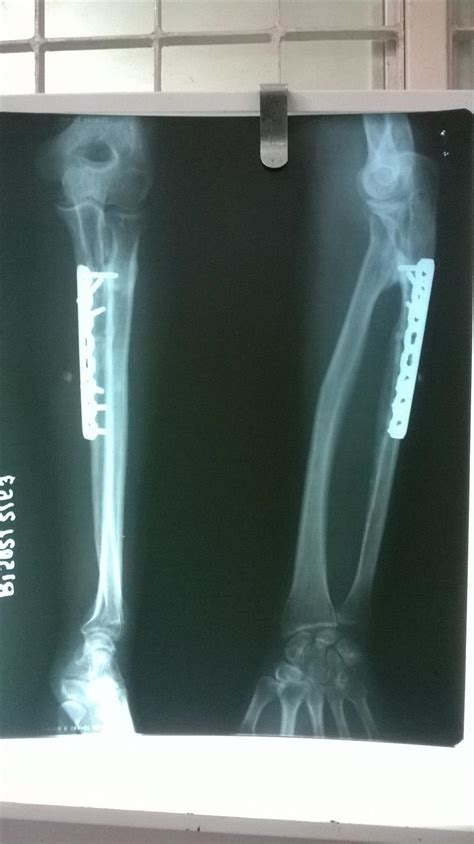 Radioulnar Synostosis - Trauma - Orthobullets