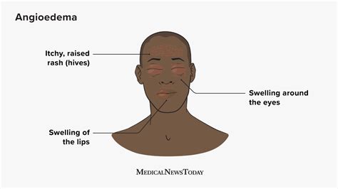 Angioedema: Symptoms, Causes, Treatment, and More