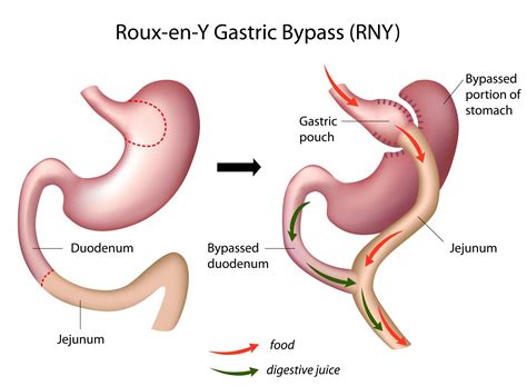 Roux En Y Procedure and All to know about it | Healing Clinic Turkey