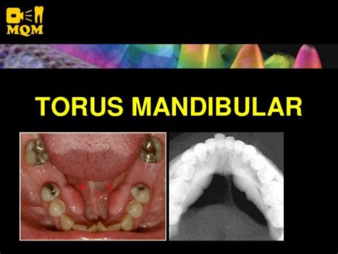 Torus Mandibular