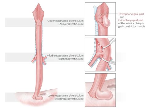 Epiphrenic Diverticulum