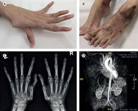 Covert Ehlers-Danlos syndrome in pregnancy - The Lancet Rheumatology