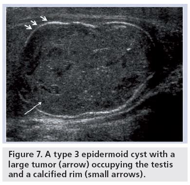 Role of ultrasound in the diagnosis of testicular lesions