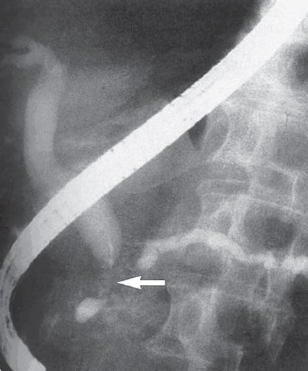 ERCP demonstrating a classic “double duct” sign. The arrow shows tumor ...