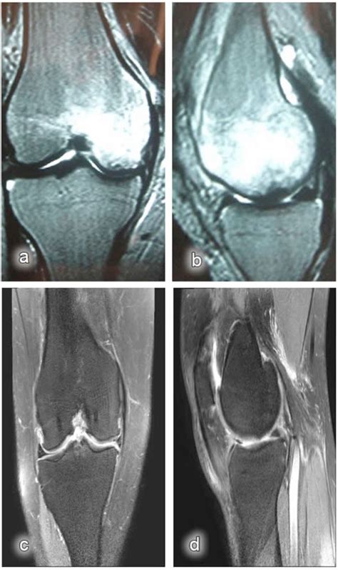 Determining Bone Bruises of the Knee with Magnetic Resonance Imaging