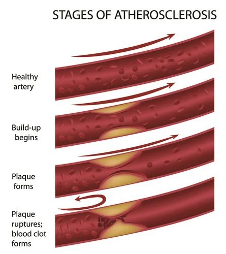 Atherosclerosis Treatment Service in Kolkata | ID: 16980084797