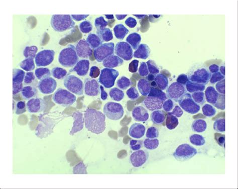 Bone marrow aspirate demonstrating increased atypical monocytes with a... | Download Scientific ...