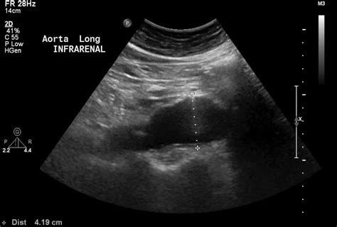 Abdominal Aortic Aneurysm (AAA) - Stepwards