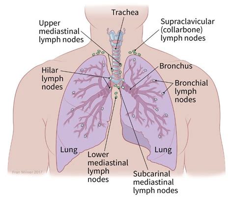 Lung Carcinoid Tumor Stages | Staging Lung Neuroendocrine Tumors ...