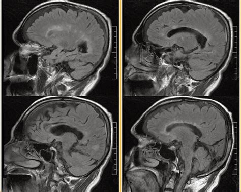 Dr Balaji Anvekar FRCR: Multiple Sclerosis MRI