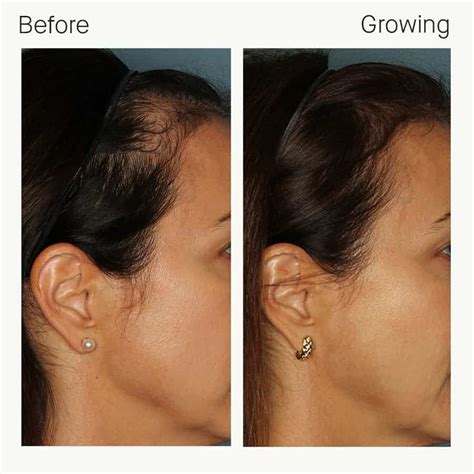 Nutrafol - Before and After | Columbia Laser Skin Center