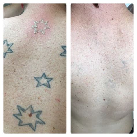 How to Fade Tattoo at Home: A Guide to Safe and Painless Tattoo Removal