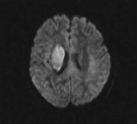 Basal Ganglia Stroke Mri