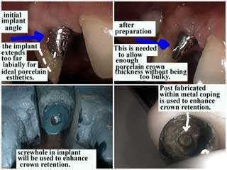 Dental crown complications and problems–