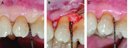 Residual periodontal pocket of 5 mm (A), at the surgical opening (B ...