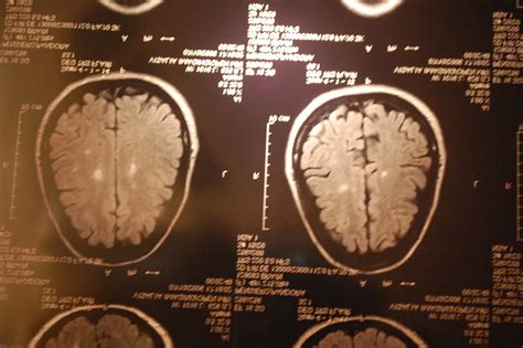 Mri Brain Scan Results White Spots