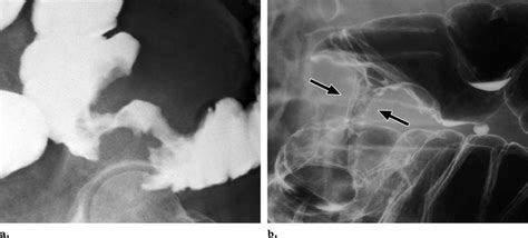 Apple core lesion. (a) Image from a single-contrast barium enema... | Download Scientific Diagram