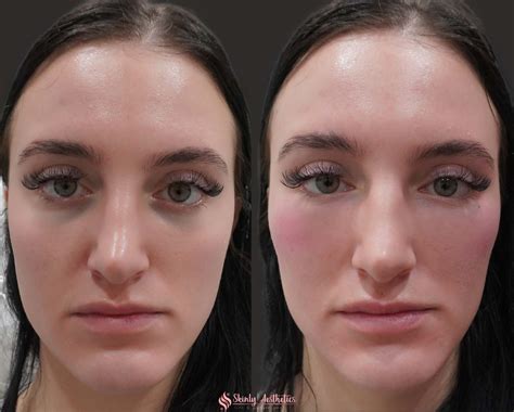 Juvederm Fillers - Benefits, Costs, Results & Procedure Steps