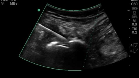 Hip Ultrasound: Iliopsoas Bursa Corticosteroid Injection - YouTube