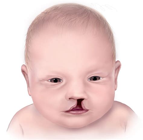 Cleft Palate & Cleft Lip - Causes, Symptoms, Repair, Surgery