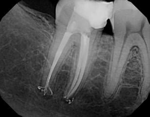 Case Study: Apical Delta | Micro Endodontics of Las Vegas in Las Vegas, NV 89129