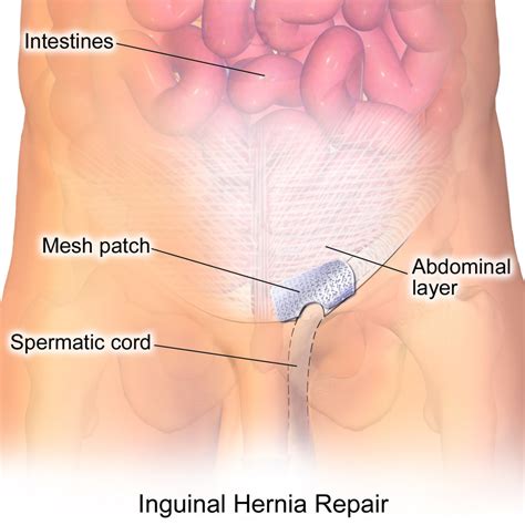 McCallister Law Group provides legal advise regarding Hernia Mesh