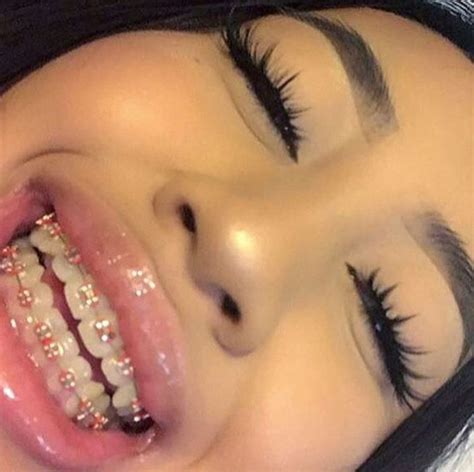 ριnтresт: @kay47shawty | Cute braces, Teeth braces, Pink braces