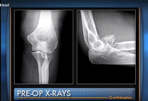 ORIF of Radial Head fracture — OrthopaedicPrinciples.com