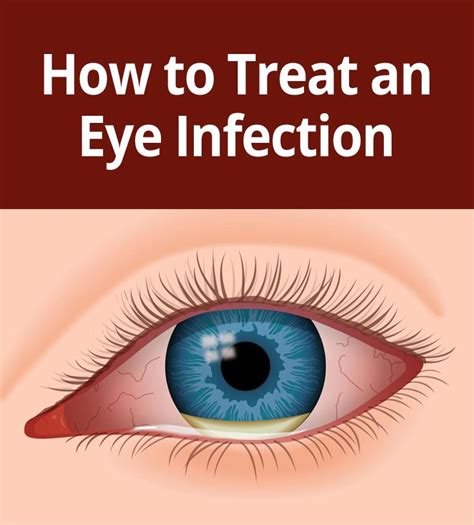 How to Tell if You Have an Eye Infection | Eye infections, Bacterial ...