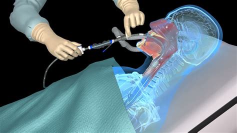 Tracheostomy Tube Suctioning