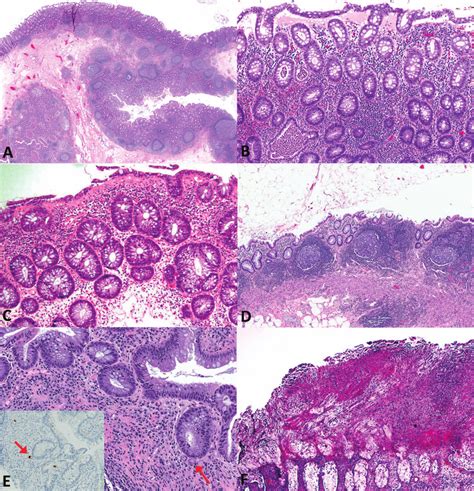 A, Scanning view of diverticular disease–associated colitis. B,... | Download Scientific Diagram