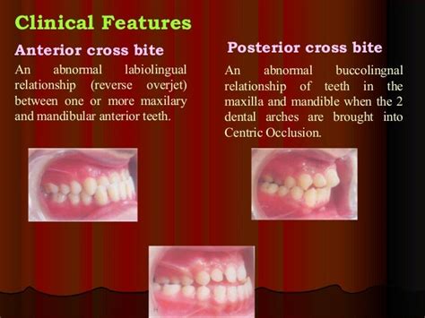 Crossbite ortho_