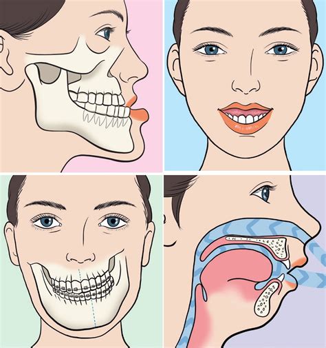 What is Orthognathic Surgery?