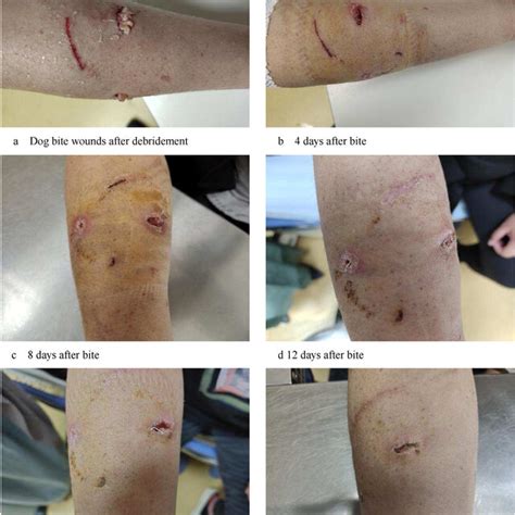 Macroscopic view of wound healing process after dog bite. Note: The... | Download Scientific Diagram