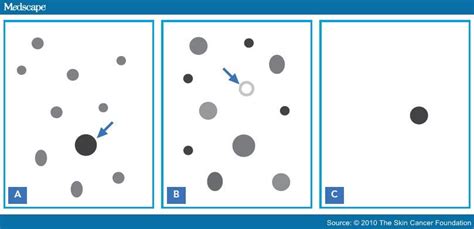 "Ugly Duckling" Sign: Early Melanoma Recognition Tool