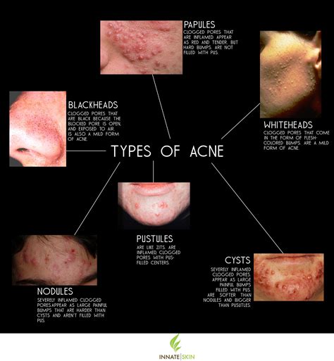 How To Recognize What Kind Of Acne You Have Innate Sk - vrogue.co