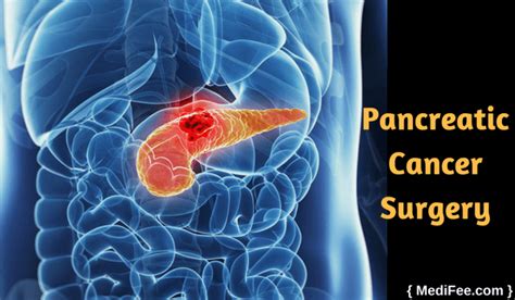 Understanding Pancreatic Surgery Benefits Risks And Relevant Anatomy ...