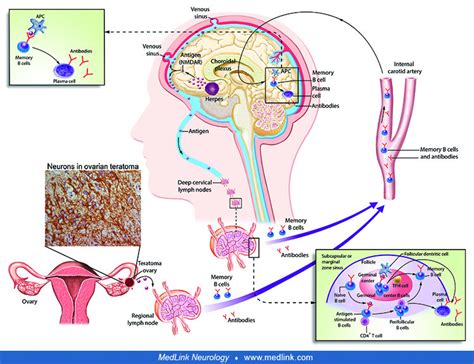 Anti-NMDA receptor encephalitis | MedLink Neurology