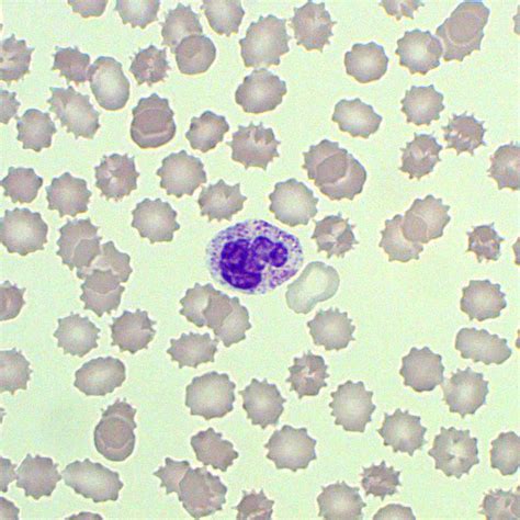 Toxic Granulation In Neutrophils