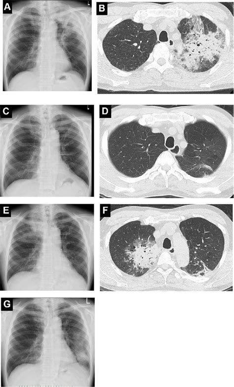 (A, B) Chest X-ray and chest CT scan in October 2012. Patchy ...