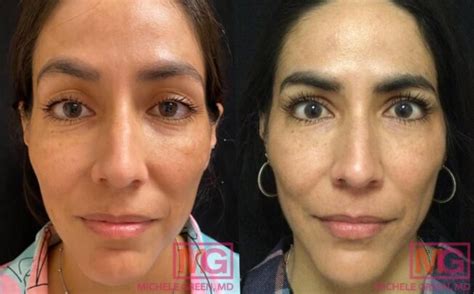 Restylane Eyelight Under-Eye Filler - Dr. Michele Green M.D.