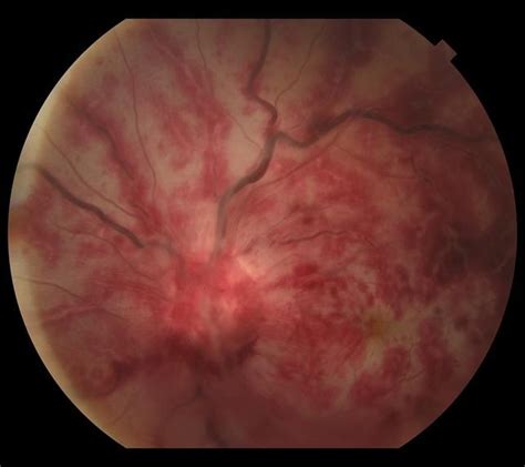 Acute ophthalmic artery occlusion in a COVID-19 patient on apixaban: Swaraj Bose, MD: Neuro ...